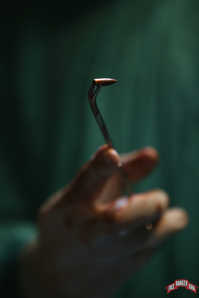 The M16 bullet removed.