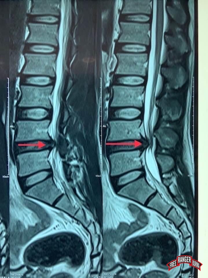 MRI is of Silverhorn's lumbar nerve impingement.