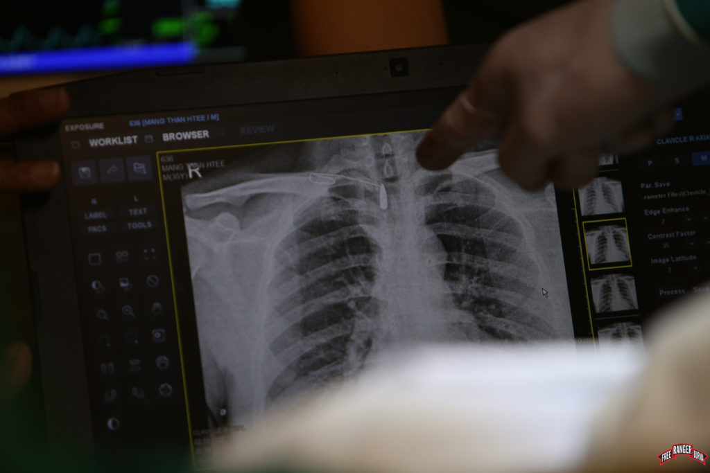 Locating the bullet with serial x-rays and a paperclip.