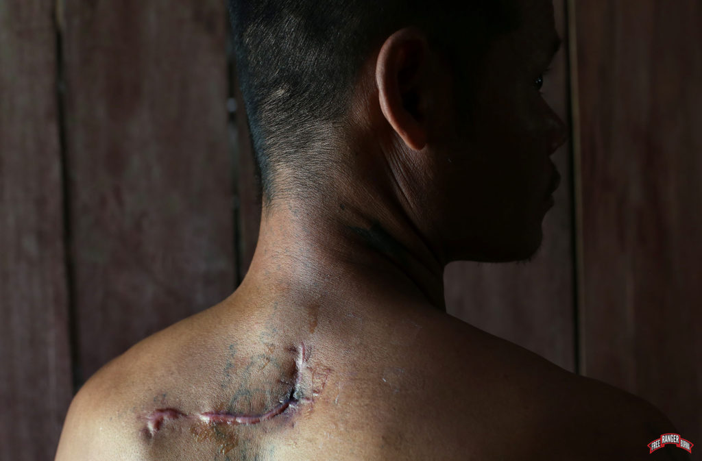 Patient’s surgical scar after the bullet removal.