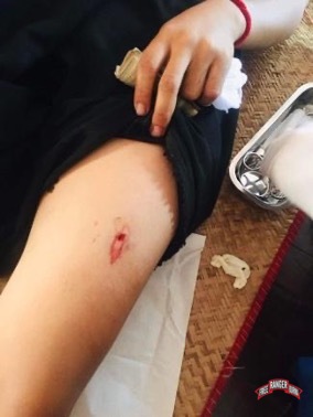 The bullet that was shot at Nan Moe Moe Lwin and her wound.