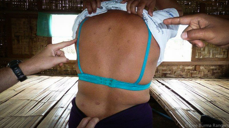 Kachin teacher wounded in Burma Army mortar attack that killed one of her students