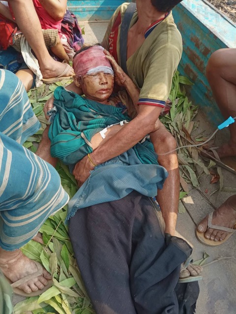 Naw KuKu Poe, 46 years old, injured by Burma Army mortars on 8 March 2023.