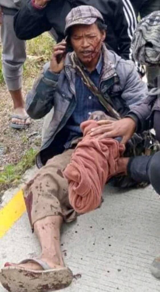 Landmine victim in Burma.