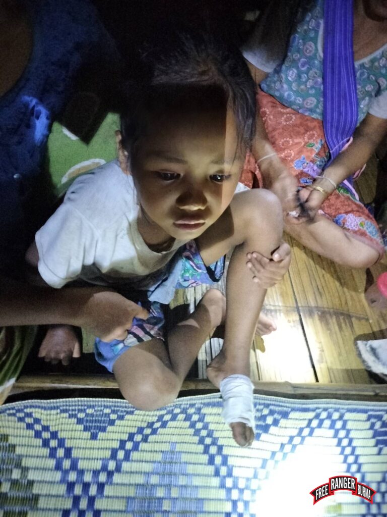 10-year-old boy wounded by Burma Army mortar fired into his village on 30 June 2023.