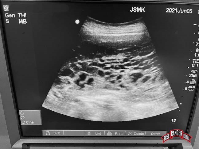 Molar pregnancy viewed with ultrasound.