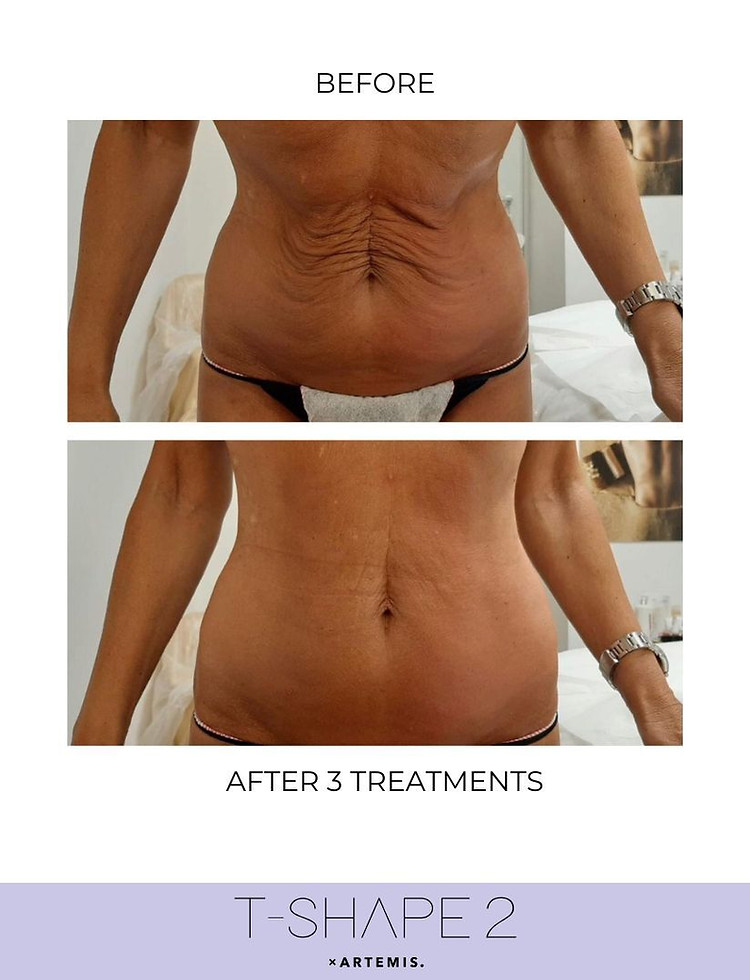 skin tightening in Harrisonburg VA