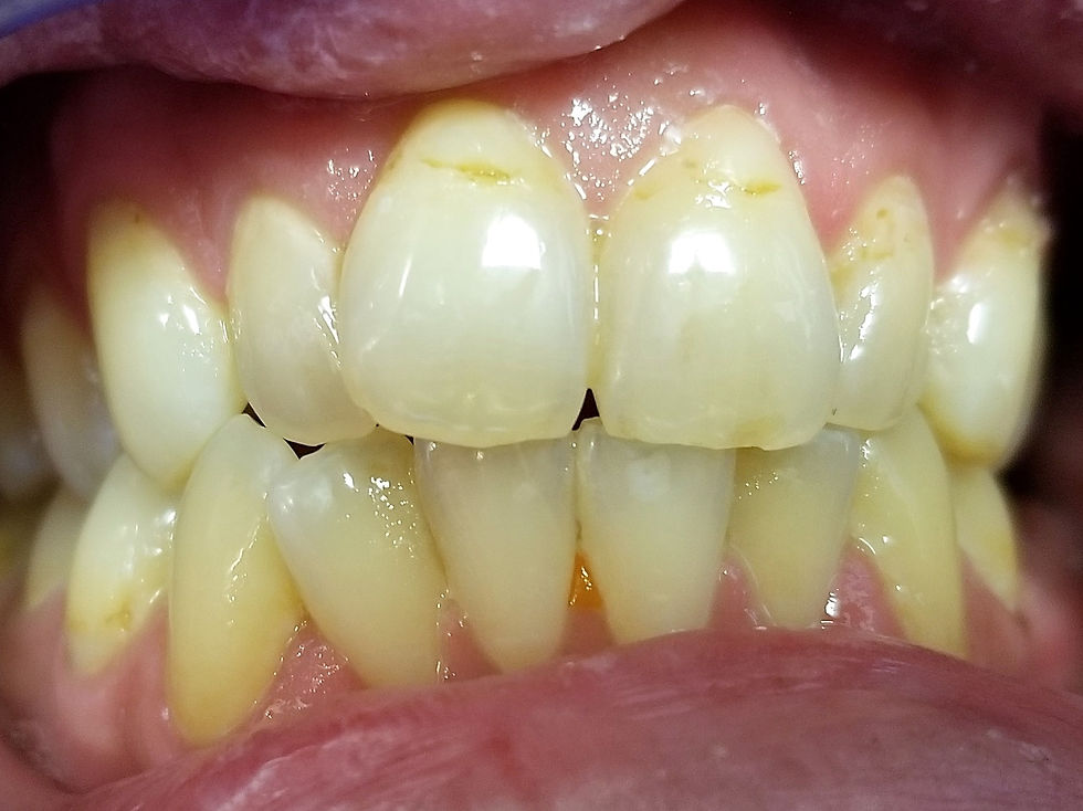 Let's replace those discolored bondings that draw attention!