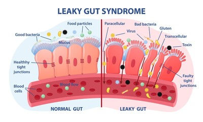 diagram of leaky gut