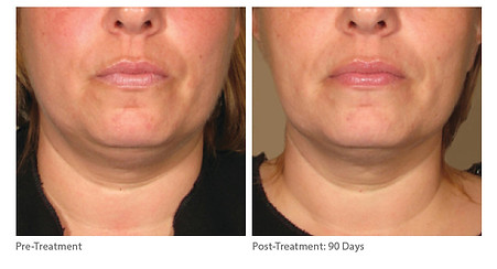 Micropeel and Skincare Before
