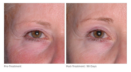 Micropeel and Skincare Before