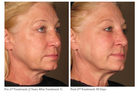 Micropeel and Skincare Before