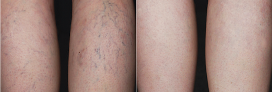 Before and After_edited.png