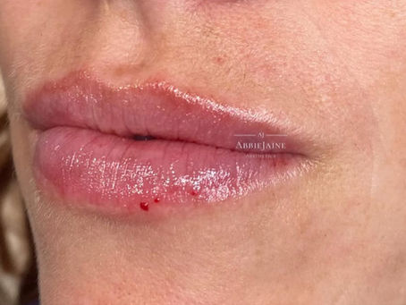 Dermal Fillers in Basildon: Enhance, Restore and Rejuvenate Naturally