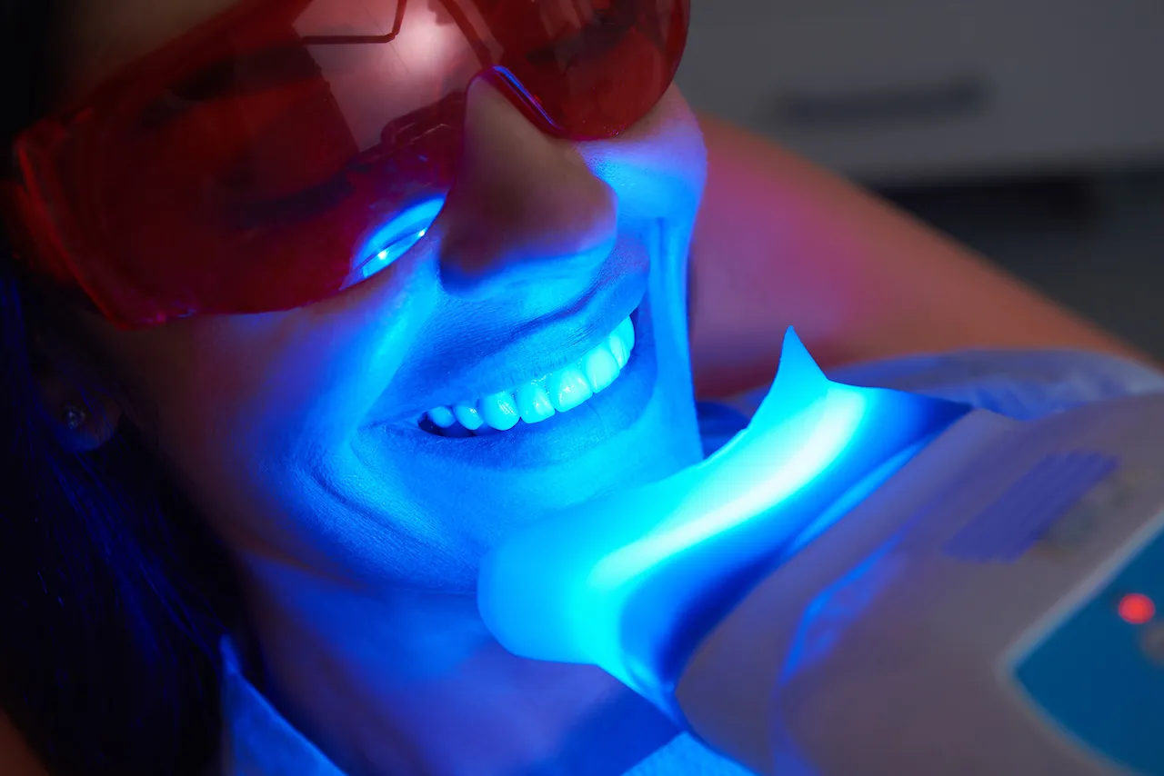 Professional Laser Teeth Whitening - Deluxe Single Treatment