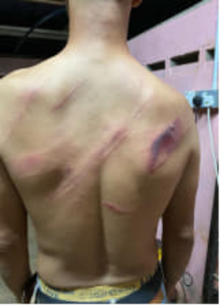 A person with visible injuries on their bare back stands in a dimly lit room with pink walls and a power outlet visible.