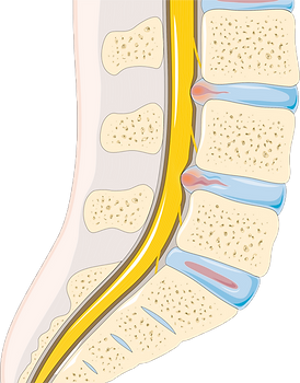 Disc_herniation_--_Smart-Servier.png