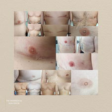Nipple Tattooing Pro Cosmetic Tattoo Brisbane Australia