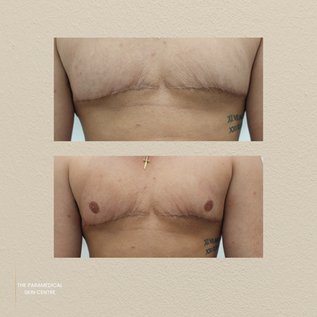 Paramedical Skin Top Surgery Nipples
