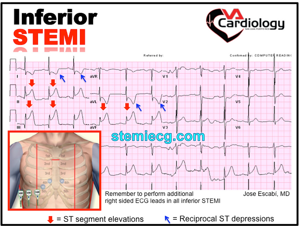 33 12 50 20 >> Mastering STEMI ECG 33 12 50 20 >> Mastering STEMI ECG