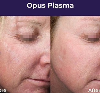 Opus Plasma example img 2_edited_edited_