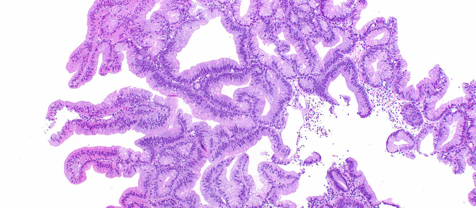 Gastric Foveolar-type Adenoma