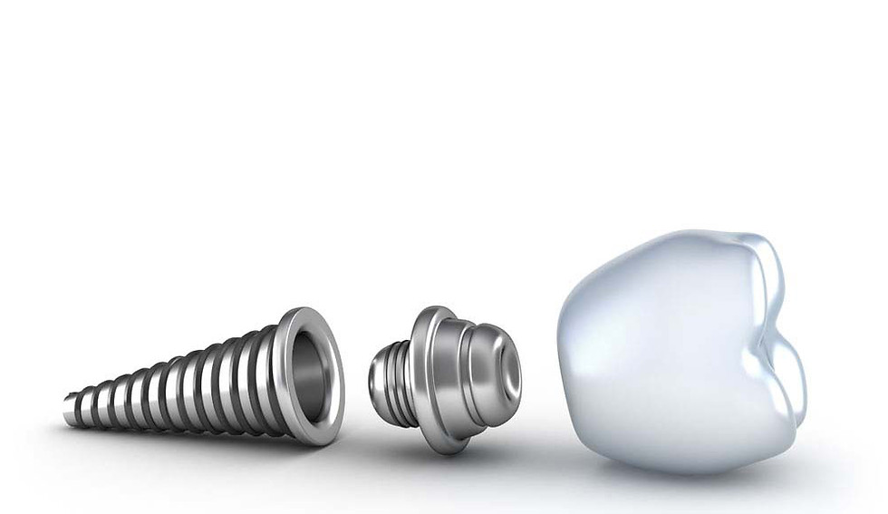 Dental_Implants-10.jpg