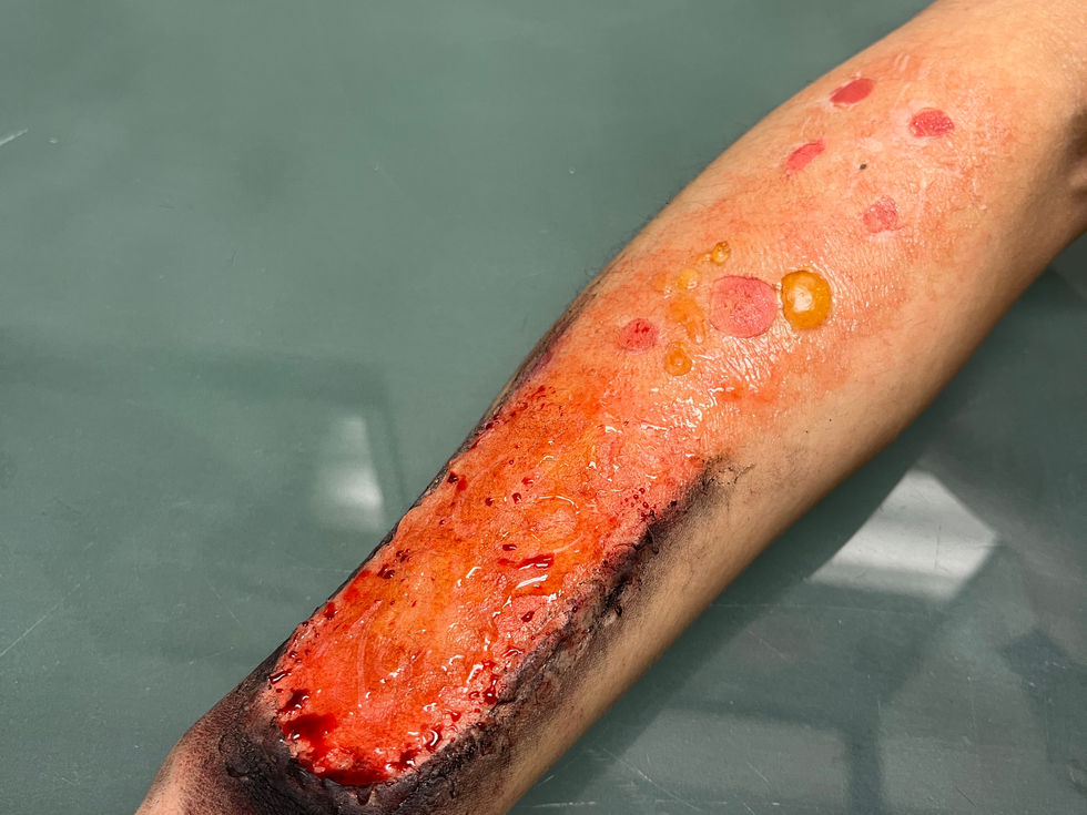 Hand-painted Burns from 1st, 2nd, to 3rd Degree