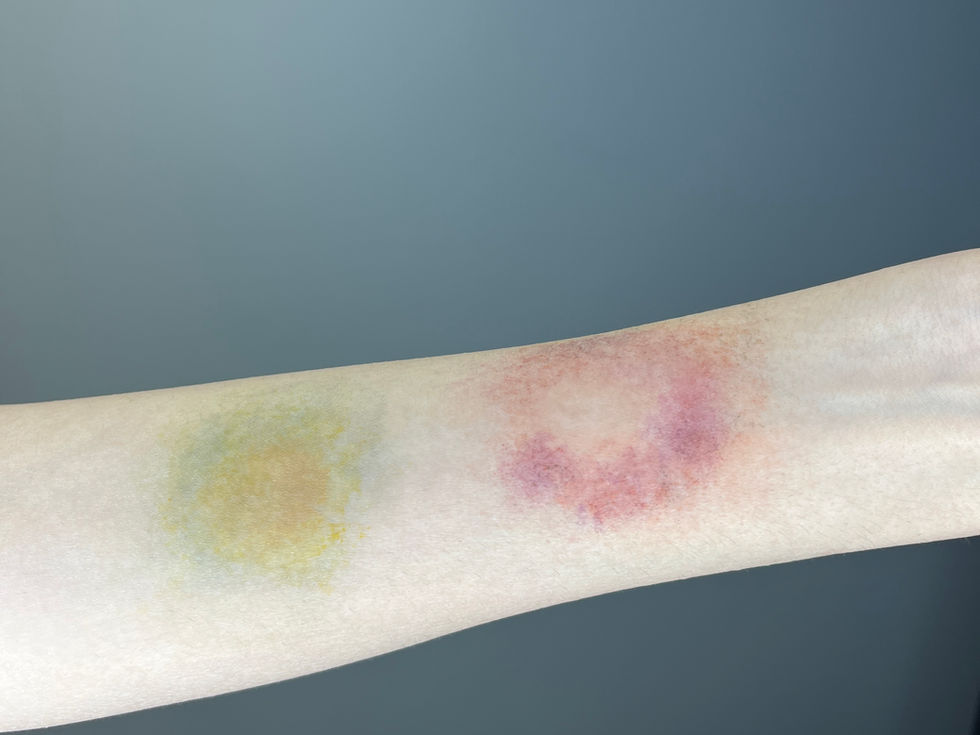 Different Stages of Bruising (Healed & Fresh)