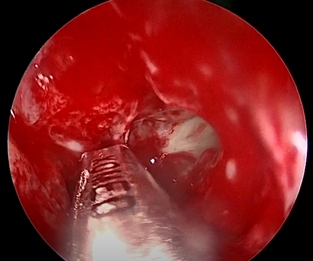 Cirugía para Sinusitis Crónica