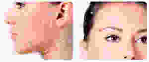 Vectors of Silhouette soft we use for the Facelift in Cornwall, MEDfacials, Aesthetic clinic, Fillers, Cornwall, Botox Truro, Eye lift, Wrinkles