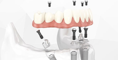 protocolo all on four clinica premium.jpeg