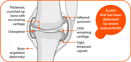 Osteoarthritis: it's not Greek to me