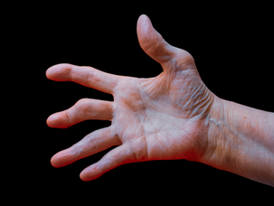 Does Medical Cannabis Help Treat Rheumatoid Arthritis?