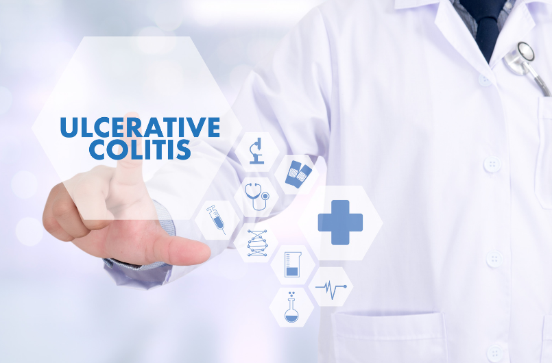 A doctor evaluating several treatment options for ulcerative colitis