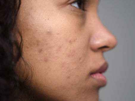 Why Your Breakouts Won't Clear: 3 Mistakes I See Most as an Esthetician