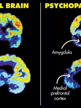 The Pathology of Sadism