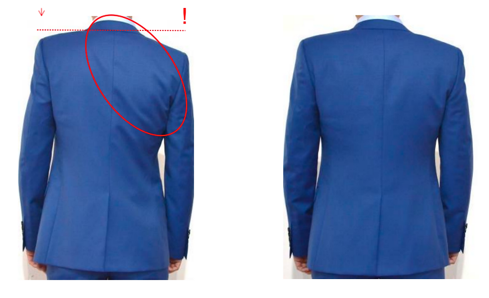 Uneven shoulders -Before and After correction