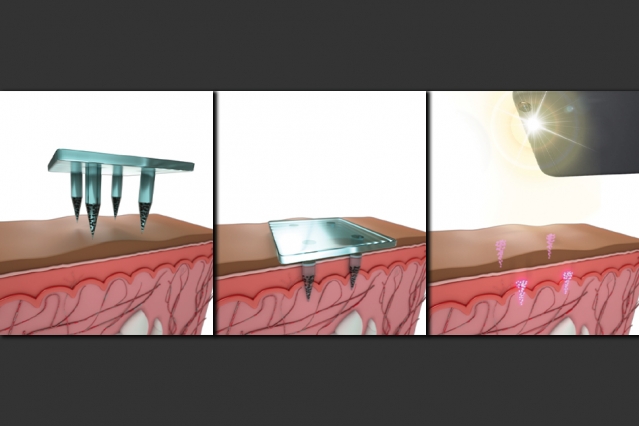 MIT engineers have developed a way to store medical information under the skin, using a quantum dot dye that is delivered, along with a vaccine, by a microneedle patch. The dye, which is invisible to the naked eye, can be read later using a specially adapted smartphone. @ Second Bay Studios