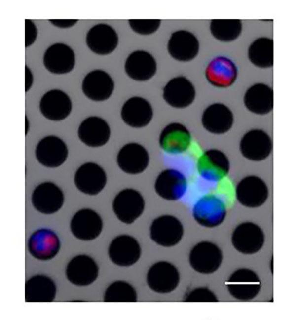 Pathology labs mounted on chips are set to revolutionize the detection and treatment of cancer by using devices as thin as a human hair to analyze bodily fluids. The technology, known as microfluidics, promises portable, cheap devices that could enable widespread screening for early signs of cancer and help to develop personalized treatments for patients, said Ciprian Iliescu, a co-author of a review of microfluidic methods for cancer analysis published in the journal Biomicrofluidics. This image shows circulating tumor cells trapping on a porous membrane using microfluidics (scale bar is 10 mm). @ Florina Silvia Iliescu