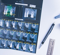 O implante dentário é um procedimento cirúrgico que tem como objetivo substituir a raiz do dente perdido por uma estrutura de titânio, que é fixada no osso da mandíbula ou maxila