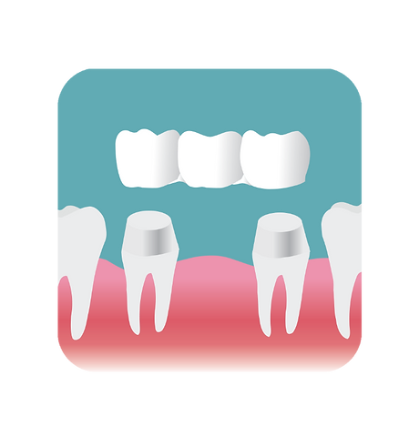 Placing a bridge on two prepared teeth