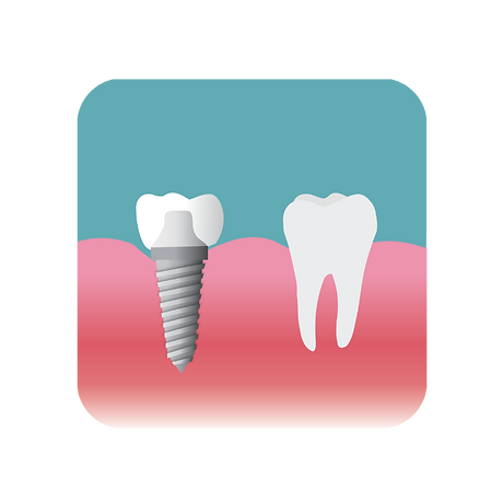 An implant with a titanium anchor rooted into the gum
