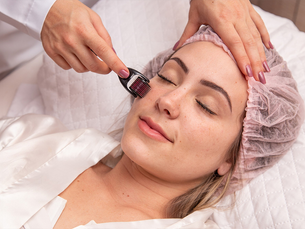 Can Microneedling Help Reduce Rosacea Symptoms Naturally?