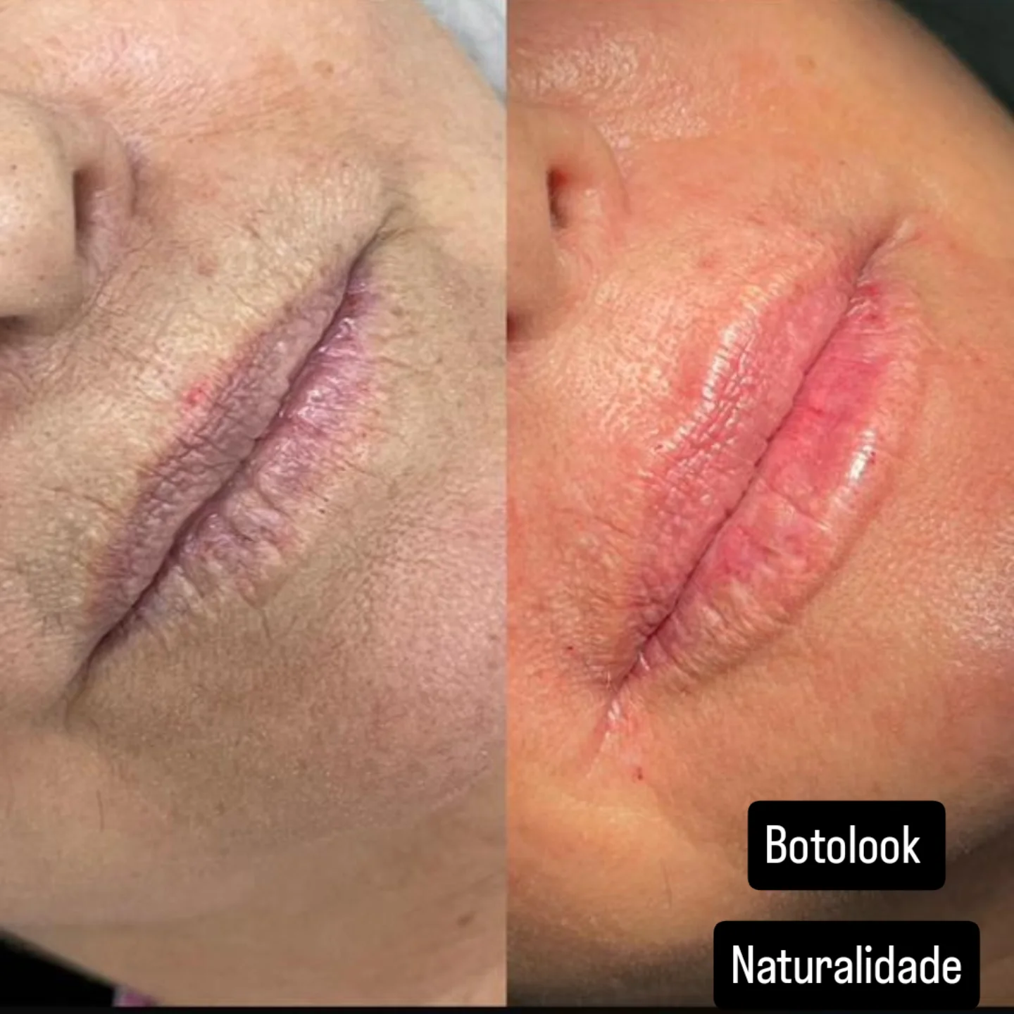 Estética facial avançada e harmonização facial com naturalidade em Rio Preto.