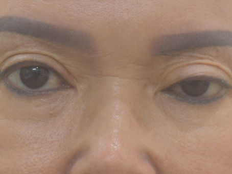 Mắt giả + Thu ngắn cơ nâng mi - Ca LS 6