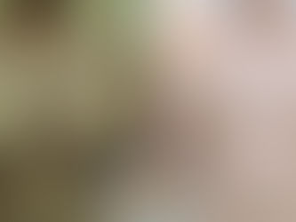 TH NGỰC NAM với sẹo ngắn nếp ngấn dưới bầu vú  