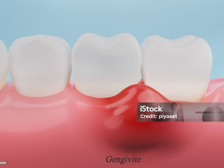 Segredos para um Sorriso Radiante: Prevenção de Cáries e Gengivite