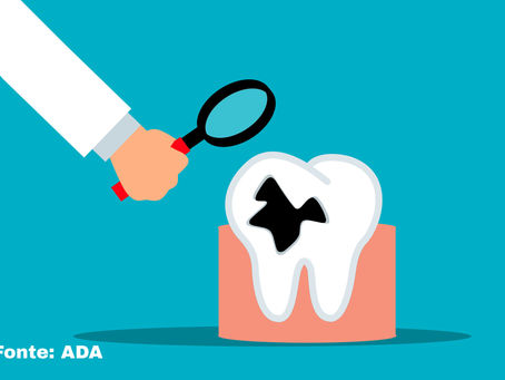Cáries nos Dentes Posteriores: Como Prevenir e Proteger Seu Sorriso