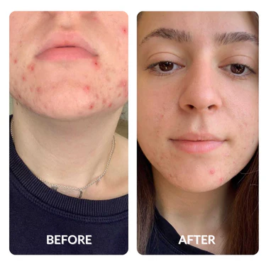 Before_and_After_Acne_Results_bu_Spacetouch_375x_crop_center.webp